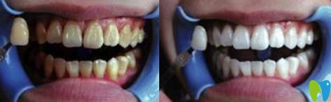 小白象口腔牙齿美白治疗前后对比图