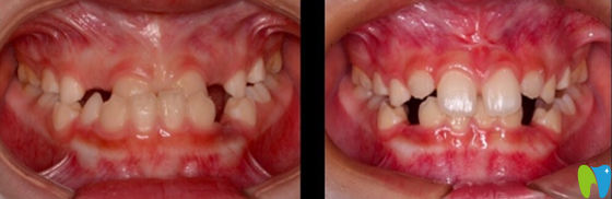 9岁的小朋友骨性反合矫正案例 9岁的小朋友骨性反合矫正案例