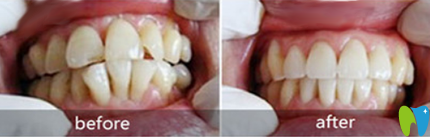 苏州拜博口腔正畸好吗?龅牙+牙齿拥挤不齐矫正案例来验证 苏州拜博口腔正畸好吗?龅牙+牙齿拥挤不齐矫正案例来验证