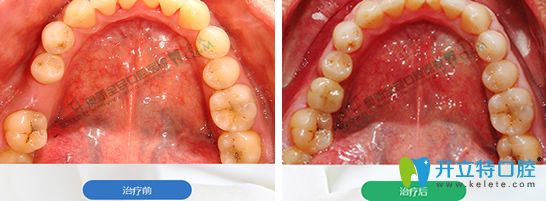 奥美口腔单颗后牙种植效果图