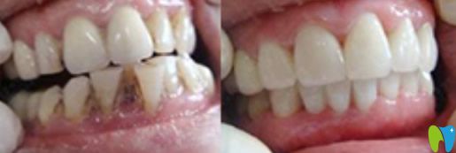 沈阳维尔口腔牙齿不齐采用美容冠进行修复案例