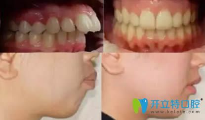南京蓝鲟口腔托槽牙齿正畸真人案例效果图