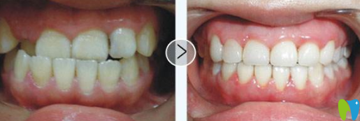 维尔口腔采用MRC肌功能矫治技术矫正儿童地包天案例效果对比