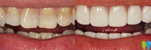 四环素牙采用牙齿冷光美白治疗前后对比案例