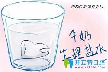 开立特口腔牙外伤脱位保存方法图