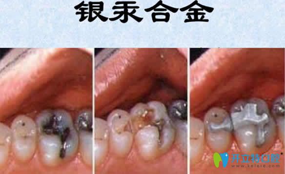 银汞合金补牙有害吗？全面介绍银汞合金补牙的优缺点
