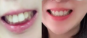 天津英瑞齿科2年多下牙套来分享我在天津英瑞齿科正畸的体验，附图哦