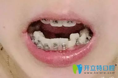 英瑞齿科正畸过程上排牙52天，下排牙19天