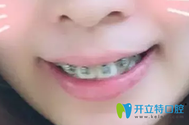 在天津英瑞齿科正畸时上排牙戴牙套第2天