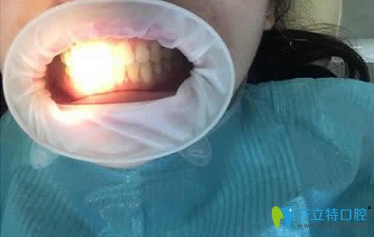 我在福州同福医口腔做牙齿美白中的照片