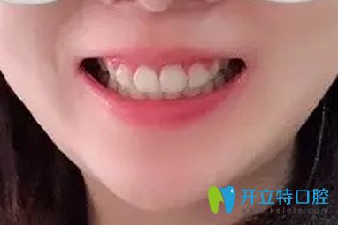 天津英瑞齿科牙齿矫正2年多照片 天津英瑞齿科牙齿矫正2年多照片