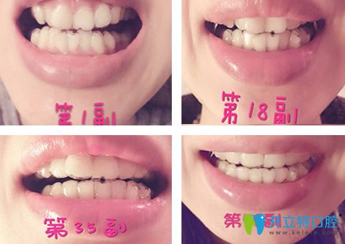 在上海美莱口腔做隐形矫正戴隐形牙套第1副-第50副变化图