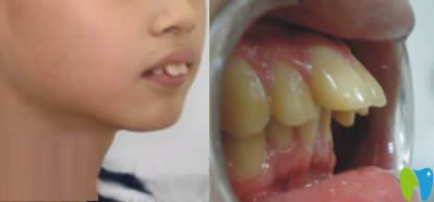 武汉牙康安口腔儿童龅牙矫正前