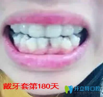我在重庆嘉悦口腔做牙齿矫正第180天效果