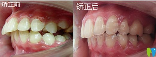 桂林瑾帆口腔好不好?真人牙齿矫正案例及术后反馈来验证 桂林瑾帆口腔好不好?真人牙齿矫正案例及术后反馈来验证