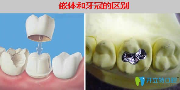牙齿嵌体和牙冠的区别