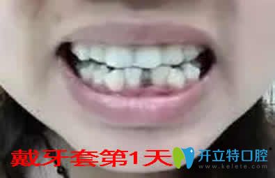 我在重庆嘉悦口腔做牙齿矫正第1天照片