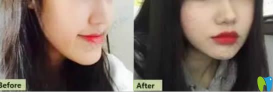 龅牙矫正案例效果及前后对比照 龅牙矫正案例效果及前后对比照
