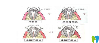 斯美尔口腔解析牙周炎易得“黑三角”
