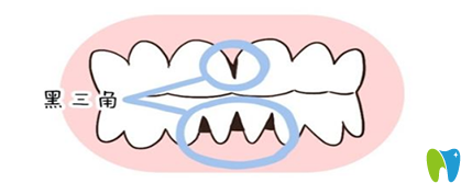 武汉斯美尔口腔解析牙齿矫正会不会导致“黑三角”