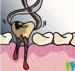 牙科口腔医生提醒:拔牙前一定要吃饱饭而且上午来拔牙