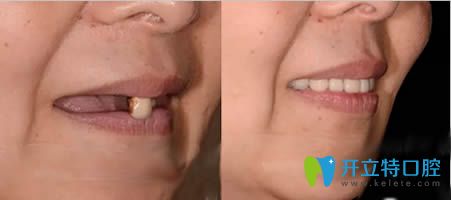 在西安拜尔口腔种植全口牙的前后对比效果