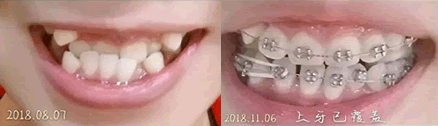 诚之康口腔周春医生做牙齿矫正的三个月对比图 诚之康口腔周春医生做牙齿矫正的三个月对比图