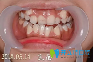 我在诚之康口腔矫正前照片 我在诚之康口腔矫正前照片