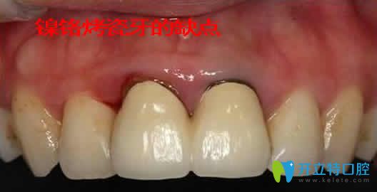 镍铬烤瓷牙的优缺点 镍铬烤瓷牙的优缺点