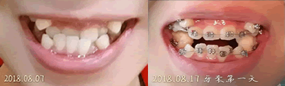 在诚之康口腔拔了四颗牙以及带上牙套天 在诚之康口腔拔了四颗牙以及带上牙套天