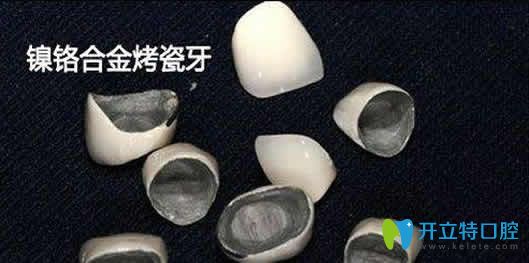 镍铬烤瓷牙的副作用 镍铬烤瓷牙的副作用