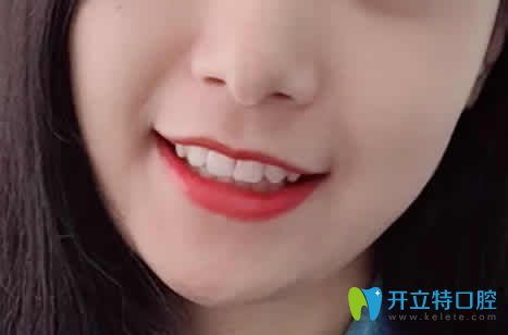 我在厦门天使口腔做牙齿矫正18个月照片 我在厦门天使口腔做牙齿矫正18个月照片