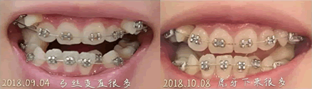 我在诚之康口腔牙齿矫正一个月效果图 我在诚之康口腔牙齿矫正一个月效果图