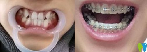 牙齿过度拥挤拔了4颗牙在重庆美格尔齿科做矫正,现在13个月