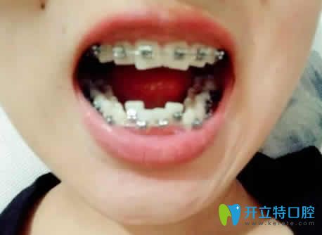 我在广州伟联口腔做牙齿矫正后个月的照片