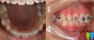 福州亚华口腔带金属托槽矫正牙齿9个月后的照片