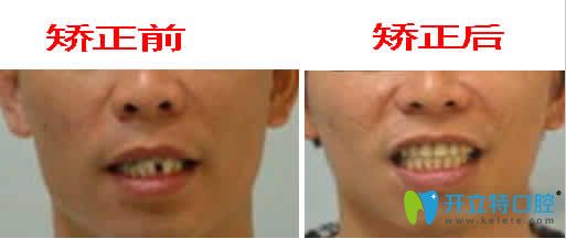 广州伟联口腔反颌矫正前后对比图