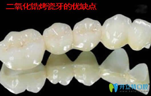 二氧化锆烤瓷牙的优缺点