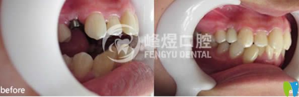 厦门峰煜口腔单颗牙缺失种植案例 厦门峰煜口腔单颗牙缺失种植案例