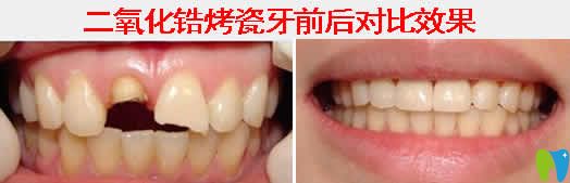 二氧化锆烤瓷牙的价格