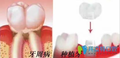 杭州植得口腔解析牙周病于种植牙的危害