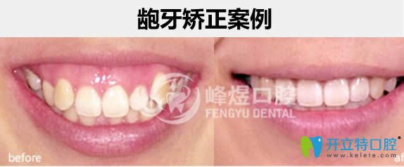 王春林医生成人龅牙矫正案例