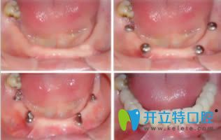 杭州植得口腔半口牙种植效果对比图