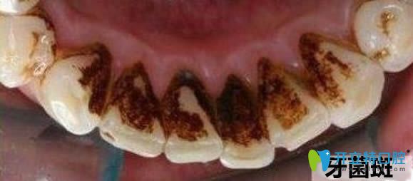 黑色牙菌斑如何去除?资深牙医告诉你清除黑色牙菌斑的妙招