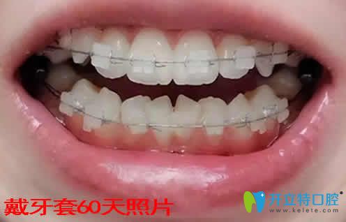 我在湛江致美口腔做牙齿矫正第60天照片 我在湛江致美口腔做牙齿矫正第60天照片