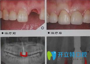 杭州植得口腔单颗牙种植效果对比图