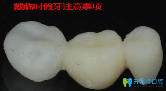 临时活动假牙能戴多久 资深牙医分享戴临时假牙注意事项 牙科治疗 开立特口腔