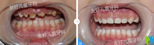 友好儿童牙科幼儿前牙龋坏美容树脂修复案例对比
