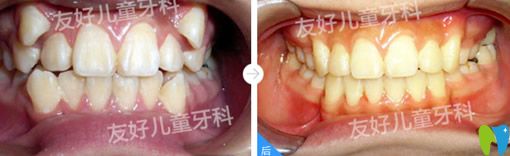 郑州友好儿童牙科怎么样？来看于瑞华儿童牙列不齐矫正案例