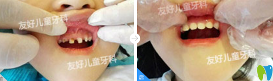 郑州友好儿童牙科幼儿上门牙龋坏美容冠修复案例